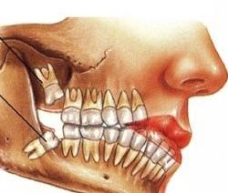 De tand is gesneden: symptomen en kenmerken